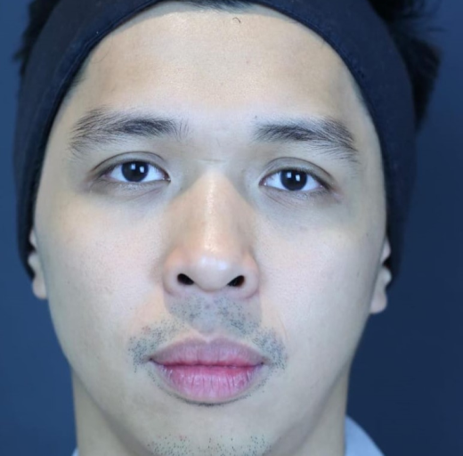 Before/After Image